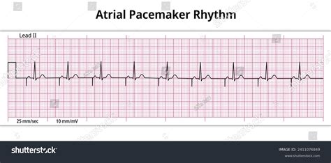 Ecg Atrial Pacemaker Rhythm Single Chamber Stock Vector Royalty Free