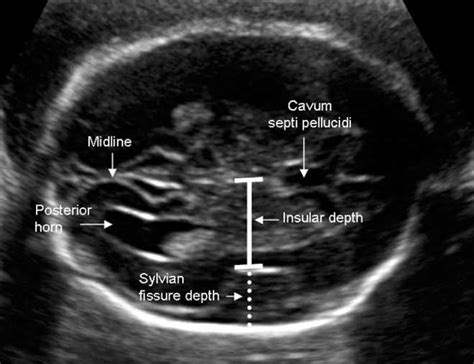 Depth of brain fissures in normal fetuses by prenatal ultrasound ...