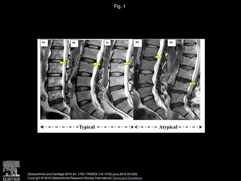 Classification Of Schmorl S Nodes Of The Lumbar Spine And Association