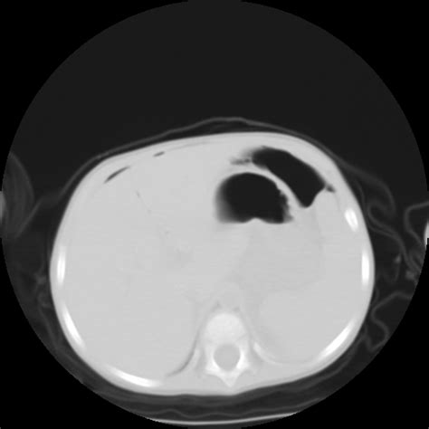 Bilateral Renal Cortical Calcification Image