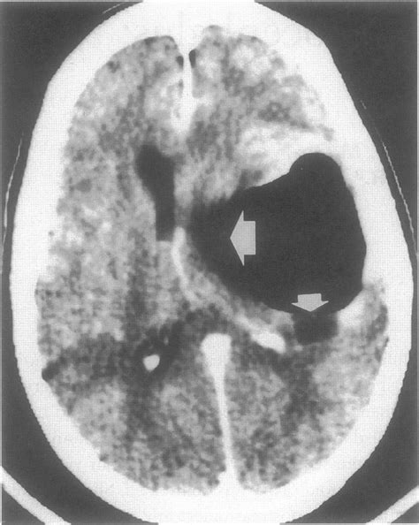 Contrast Enchanced Axial Ct Showing A Tension Pneumocephalus Air