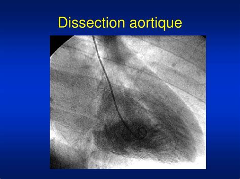 PPT La Chirurgie Cardiovasculaire PowerPoint Presentation Free