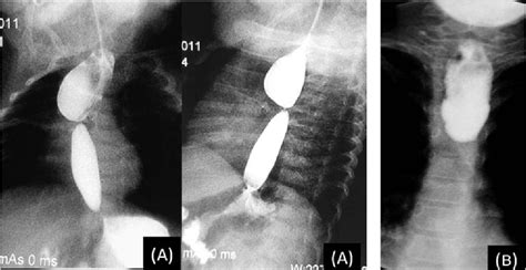 Esophageal Atresia X Ray