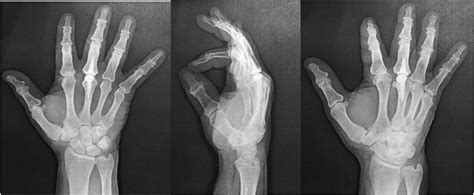 A Painful Squeaking Pyrolytic Carbon Metacarpophalangeal Joint