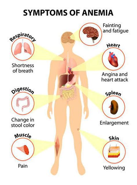 Anemia MEDizzy