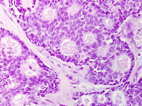 Cribriform Adenocarcinoma