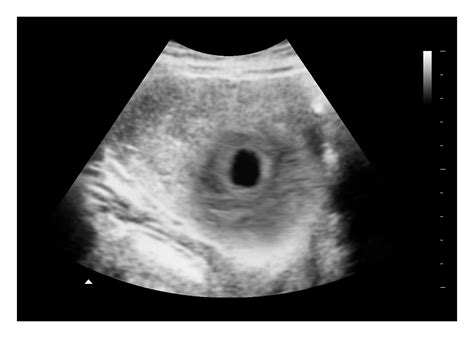 Early Miscarriage 2D Ultrasound | Realistic Fake Sonogram for Film