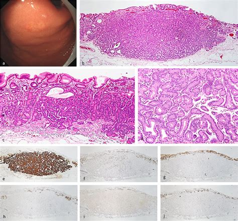 Gastric Adenocarcinoma Of Fundic Gland Type Endoscopic Image By White