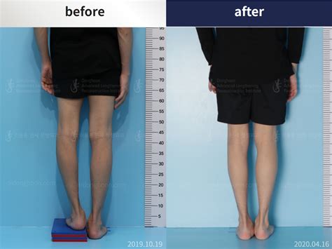 Leg Length Discrepancy Leg Lengthening Surgery Precice Stryde