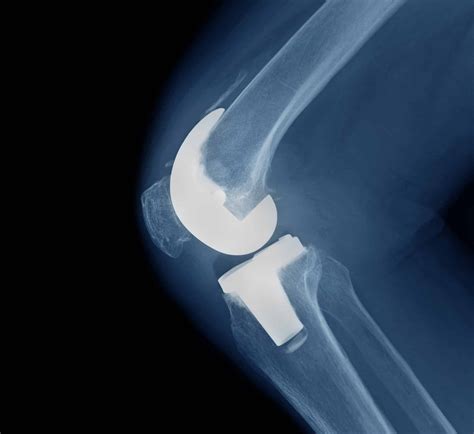 Exactech Knee And Ankle Lawsuit Joint Implant Failure