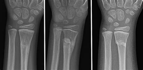 Forearm Fractures Childrens Mercy Kansas City