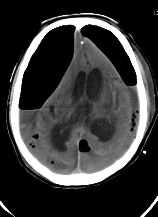 Tension Pneumocephalus-CT-Peaking Sign - Sumer's Radiology Blog