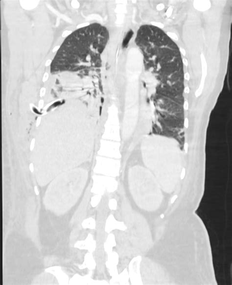 Esophageal Perforation Image Radiopaedia Org