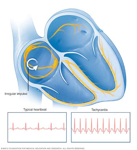 Tachycardia Disease Reference Guide