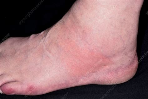 Can Gout Cause Ankle Swelling