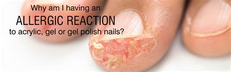 Why am I having an allergic reaction to acrylic, gel or gel polish nails?