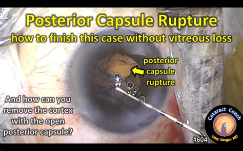 Posterior Capsule Rupture Finish The Case Cataract Coach™