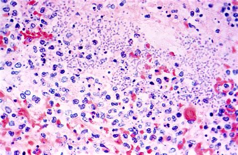 Yersinia Pestis Gram Stain