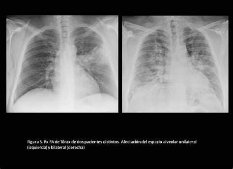 Figure 5 from Patrones Radiológicos detectados en la Radiografía Simple