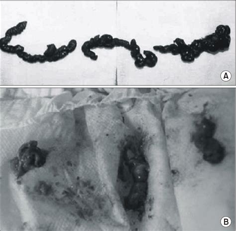 Figure 1 from Three Cases of Meconium Plug Syndrome. | Semantic Scholar