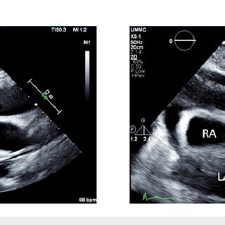 Echocardiography demonstrating tamponade physiology A: demonstrates ...