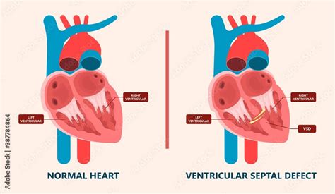 Cath Lab Atrial Septal Defect Tetralogy Of Fallot Patent Foramen Ovale