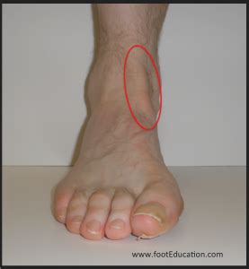 Anterior Tibial Tendonitis - FootEducation