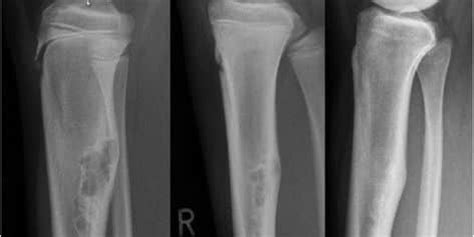 Fibroma Non Ossificante Difetto Fibroso