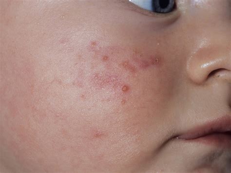 Childhood rashes and skin conditions: photos - BabyCenter Canada