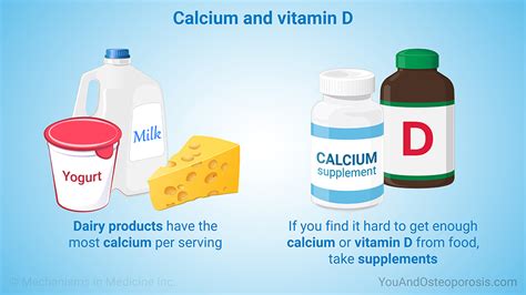 Slide Show Managing And Treating Osteoporosis