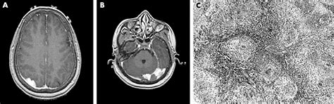 Coccidioidomycosis Of The Brain Mimicking En Plaque Meningioma Journal Of Neurology