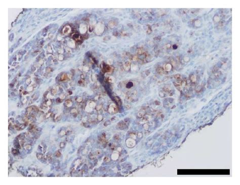 Histologic And Immunophenotypic Features Of Tlfck On Biopsy A Low