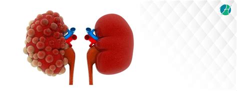 Polycystic Kidney Disease: Symptoms, Diagnosis, and Treatment – Healthsoul