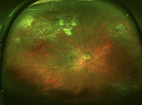 peripheral exudative hemorrhagic chorioretinopathy pehcr