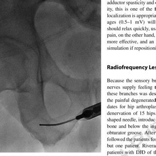 1 Patient complaints of pain from obturator nerve entrapment (Image... | Download Scientific Diagram