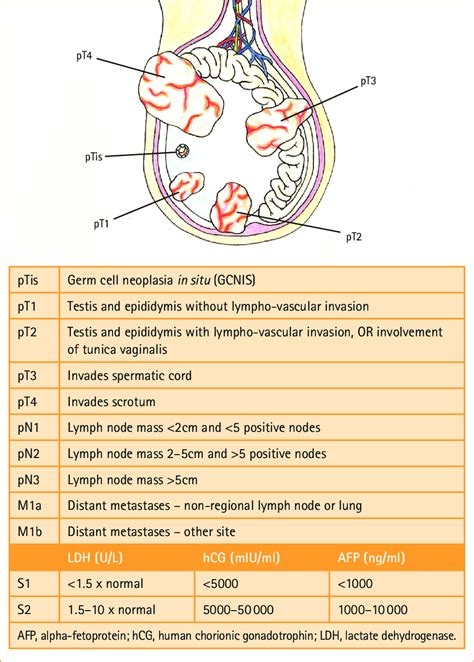 Overview Of Testicular Cancer | Hot Sex Picture