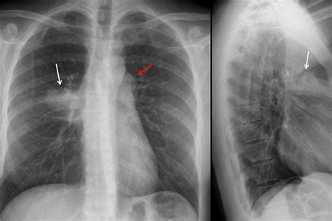 Bronchiectasie Come Si Riconoscono E Come Si Curano Emergency Live