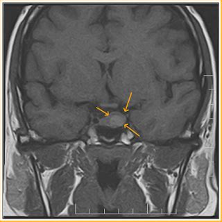 rathkes cleft cyst mri sumers radiology blog