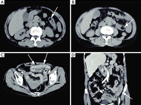 Representative Images From A Patient With Multiple Lipomas A