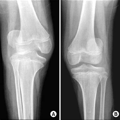 The Initial Anteroposterior Radiographs Of Both Knee A The Right