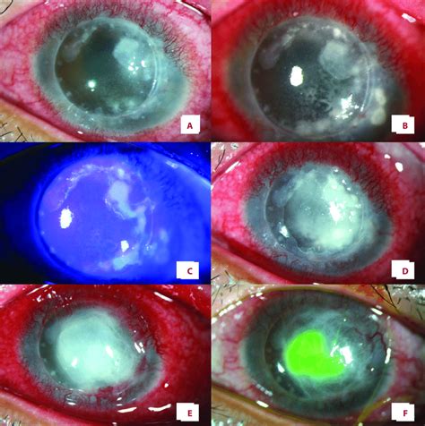 Slit Lamp Photographs Showing Clinical Progression Of Patient No 2