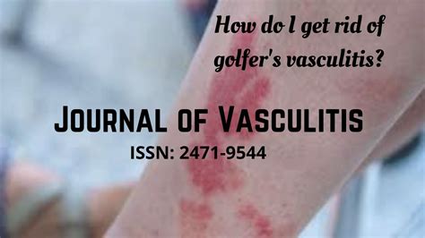 Golfers Vasculitis