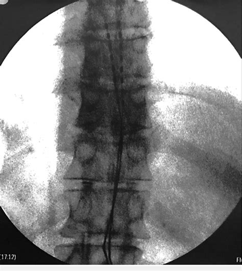 Case Intraoperative Final Anteroposterior Ap Fluoroscopic Image