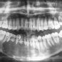 Panoramic Radiograph Showing Multilocular Radiolucency Extending From