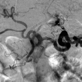 Angiographic finding. A celiac artery angiogram showing a tortuous ...