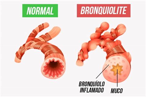 Bronquiolite como identificar e evitar que surja Tua Saúde