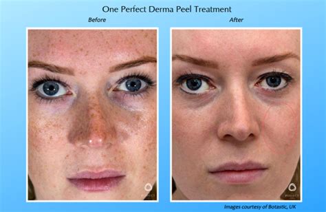 The Perfect Derma Peel Advanced Skin Body Solutions