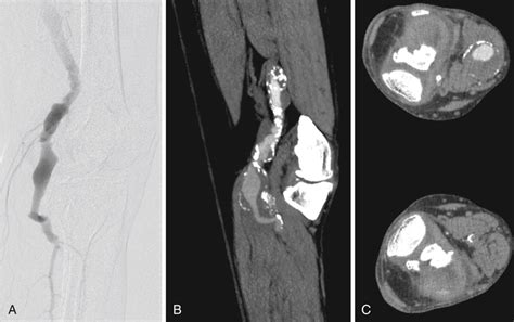 Endovascular Treatment Of Popliteal Artery Aneurysms