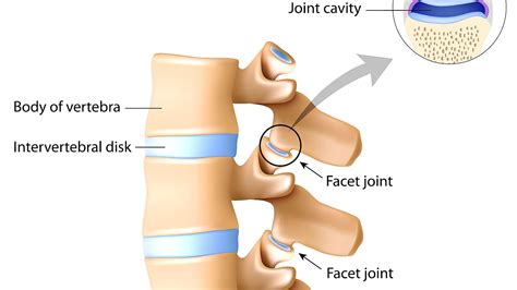 Facet syndrome - Facet Injury - Injury Choices