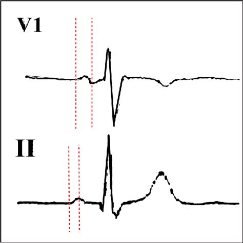 [PDF] P wave peak time and P wave dispersion in severe COVID-19 ...